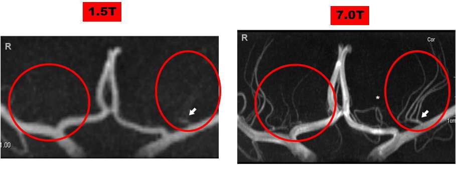 1.5T MRI와 7.0T MRI의 천공동맥 (Lenticulostriate Arteries, LSA) 영상 비교