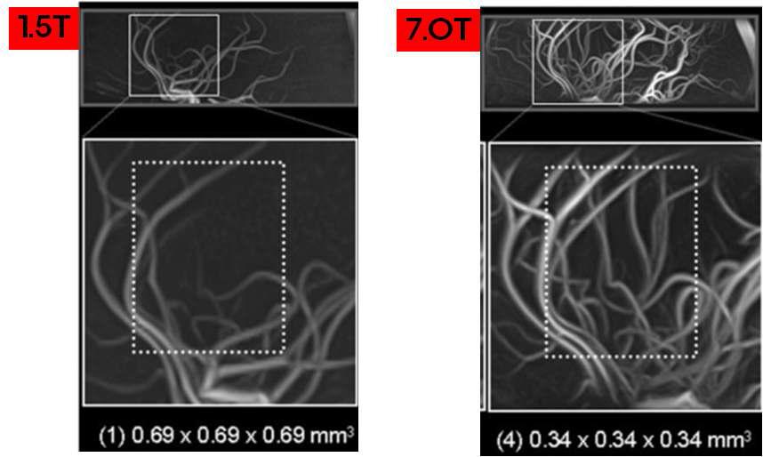 1.5T MRI와 7.0T MRI의 천공동맥(LSA) 영상 비교 (확대)