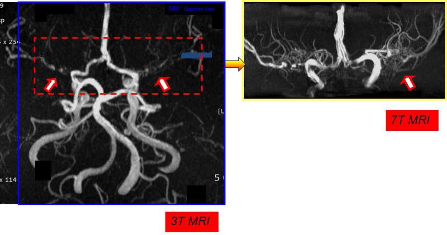 3T 영상과 7T 영상 비교. 7T영상에서 수많은 collaterals이 발견됨