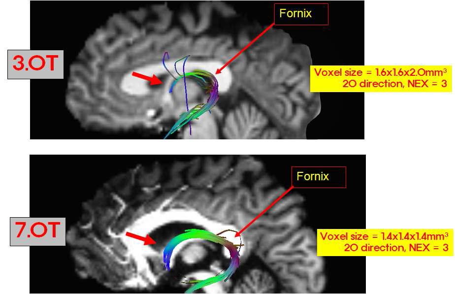 3T DTI영상과 7T DTI영상 비교