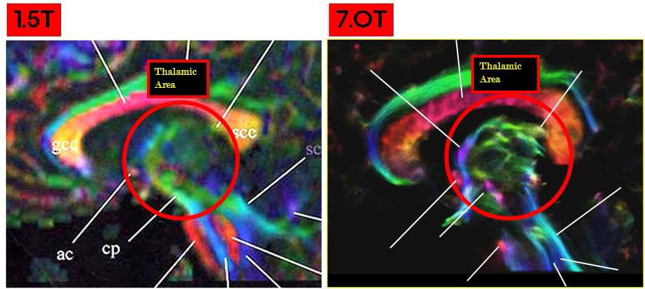 1.5T에서의 DTI영상과 7.0T에서의 TDI영상 비교