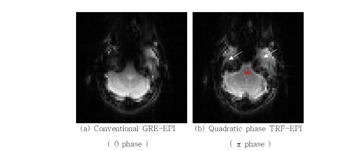 Conventional GRE-EPI와 Quadratic phase TRF-EPI (π phase)를 사용하여 얻은 MR 영상들