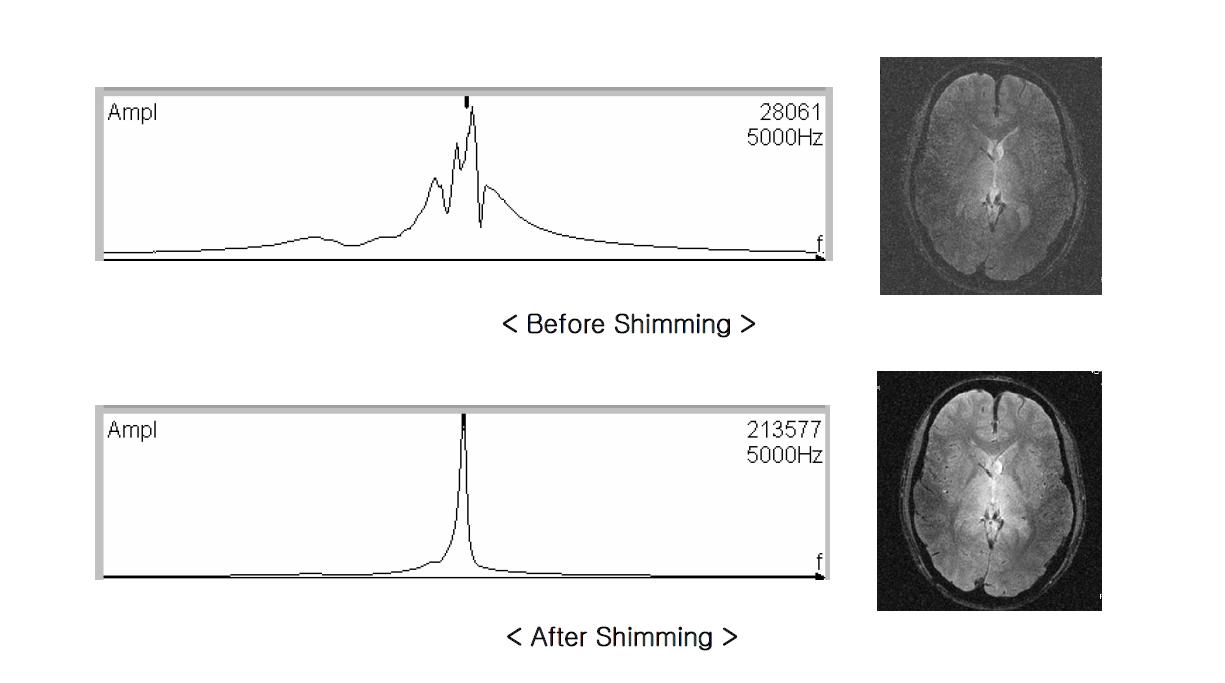 Shimming 전후의 resonance frequency 와 영상 차이