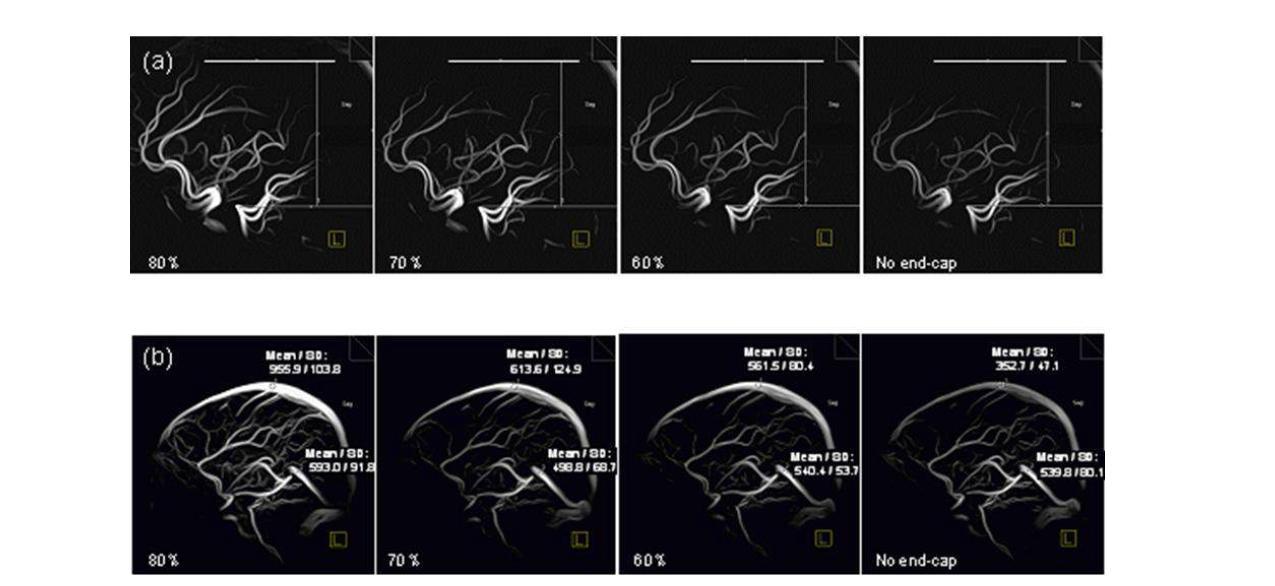 End-cap 크기에 따른 23세 건강한 남성의 MRA 시상면MIP(maximun intensity projection) 영상.