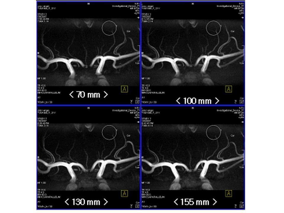 각 길이별로 얻은 lenticulostriate artery 영상