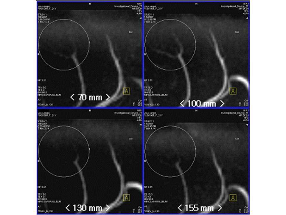 각 길이별로 얻은 lenticulostriate artery 의 확대한 영상