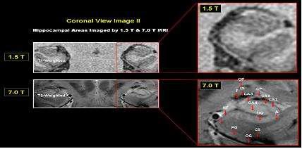 1.5T 와 7.0T MRI의 해마 영상 비교