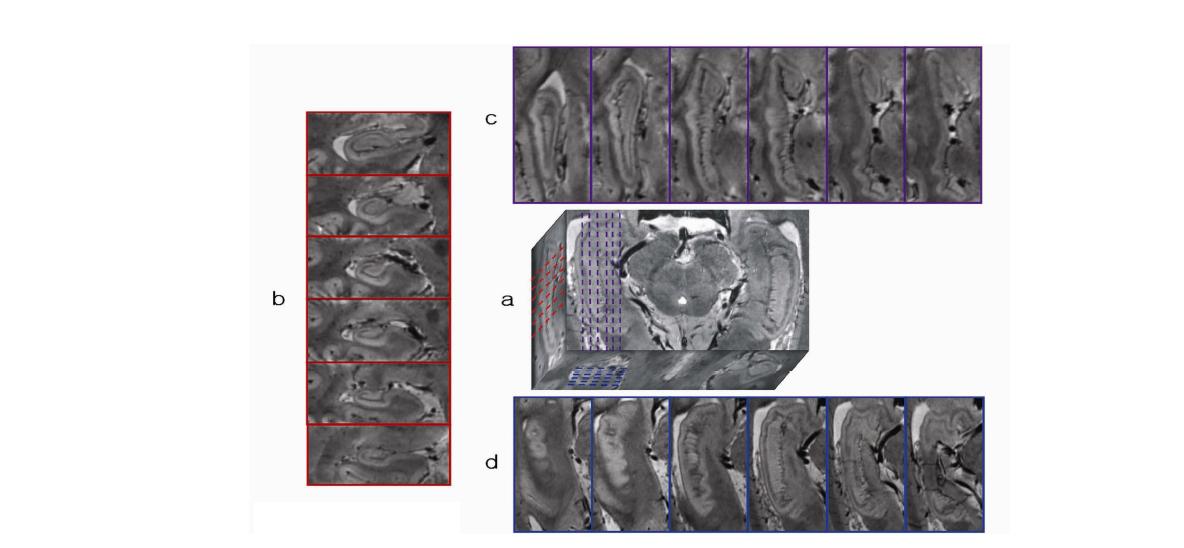 7.0T MRI를 이용하여 얻은 해마의 axial, sagittal, coronal고해상도 영상