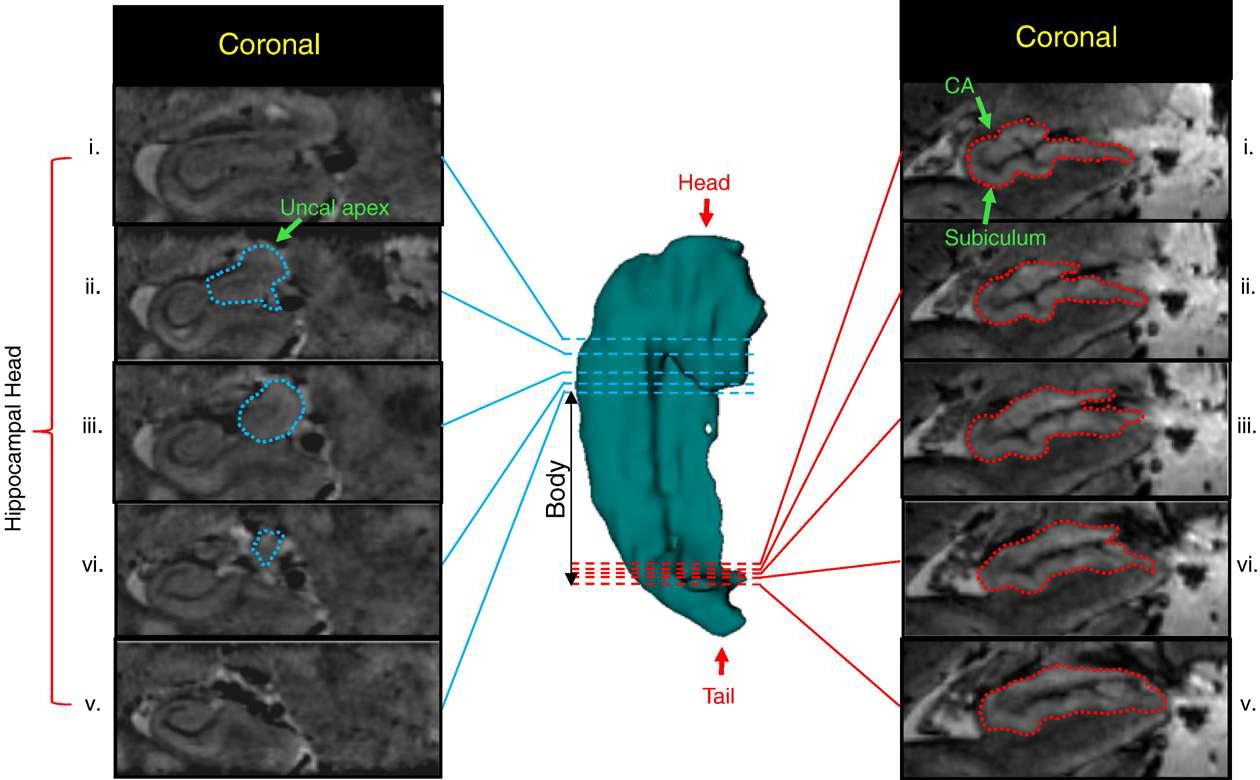 고해상도 해마 영상을 통한 해마 Head, Body, Tail 구분