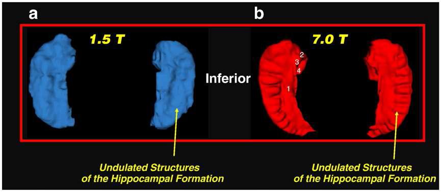 재구성한 해마의 3차원 모델 연구. (a) 1.5T 와 (b) 7.0T MRI 영상으로 재구성한 3차원 해마