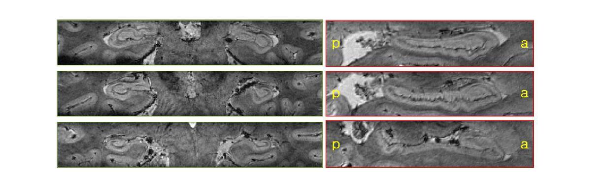 해마 (좌) 종단면과 (우) 횡단면 7.0T 영상