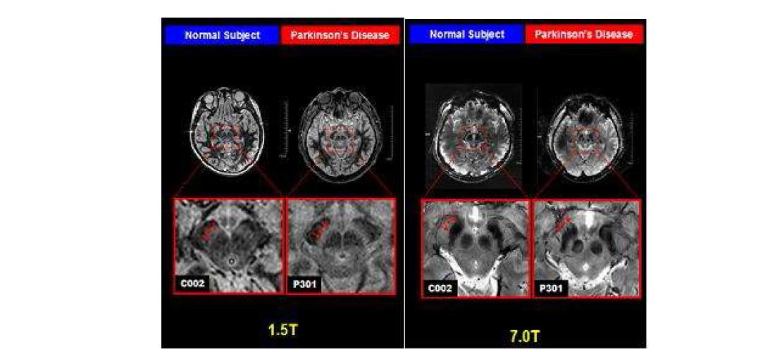 1.5T & 7.0T MRI에서 정상인과 파킨슨병 환자의 흑질 영상 비교