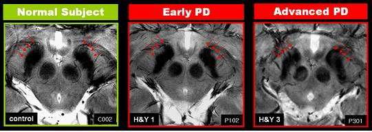 MRI에서 관찰된 정상인과 초기 파킨슨병 환자 및 중기 파킨슨병 환자의 중뇌 흑질 영상 비교