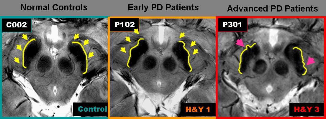 7.0T MRI에서 관찰된 정상인과 초기 파킨슨병 환자 및 중기 파킨슨병 환자의 중뇌 흑질 영상 비교