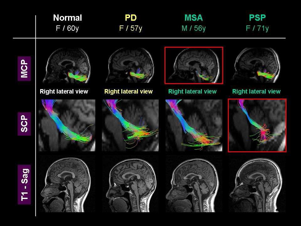 1.5T MRI 영상을 이용한 비정형 파킨슨증 (MSA, PSP)의 축삭 변성의 분포 양상 비교