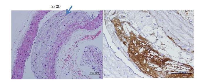 APOE마우스 대동맥 조직의 H&E 염색 소견과 CD68 (macrophage) IHC 소견