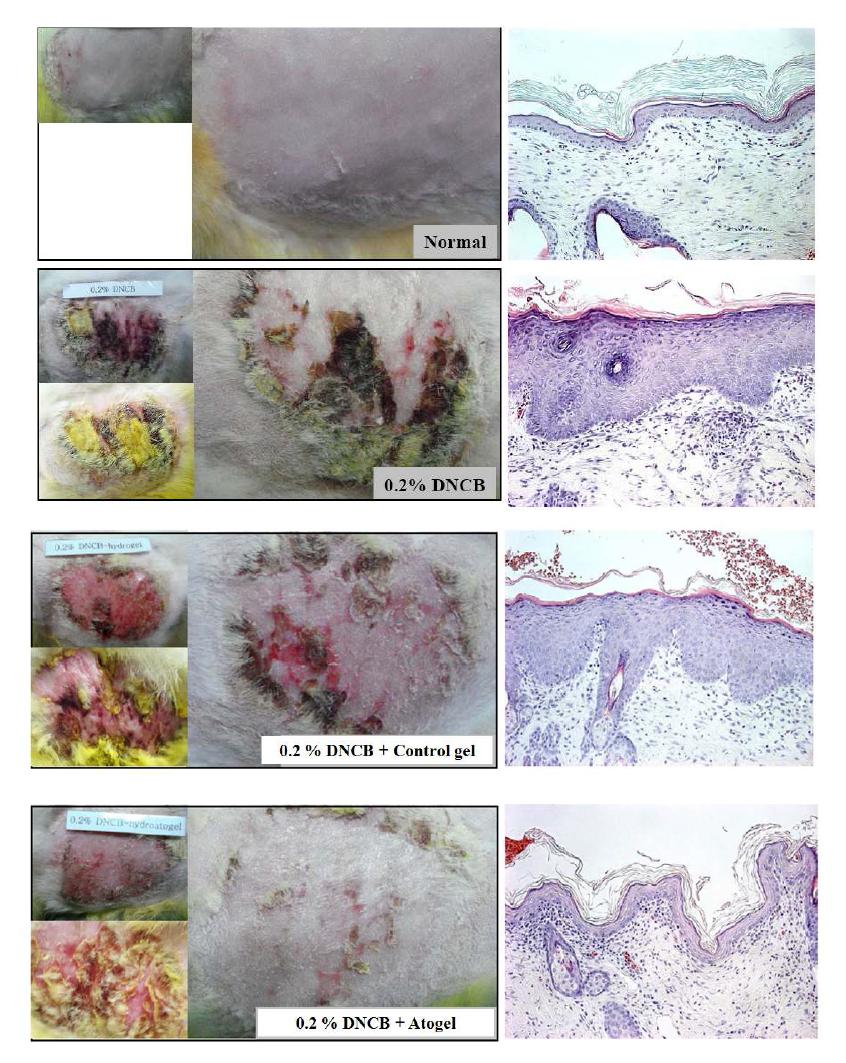 DNCB에 의해 유발된 알러지 피부염에 대한 하이드로겔의 효과