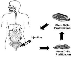 Diagram showing stem cell injection therapy for erectile dysfunction after radical prostatectomy.