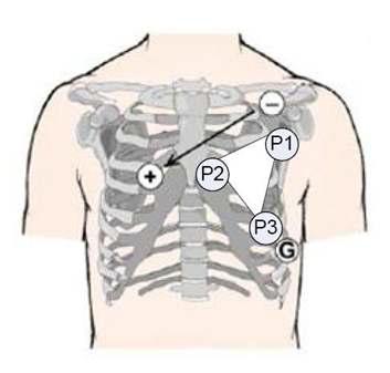 Position of three electrodes