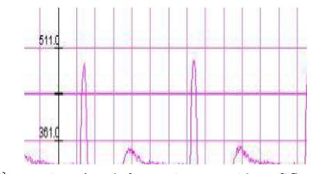 The signal from the portable ECG sensor