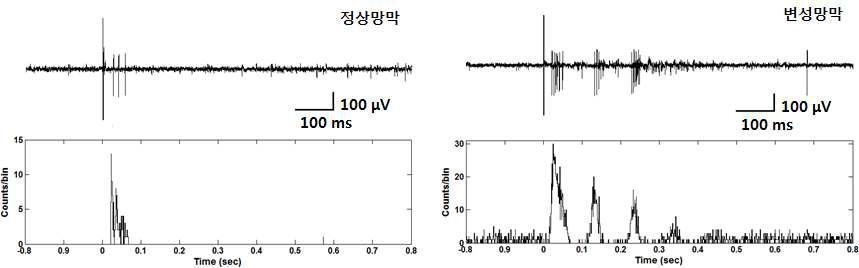 정상망막 (좌)과 변성망막 (우)의 전기자극에 대한 응답형태 및 PSTH