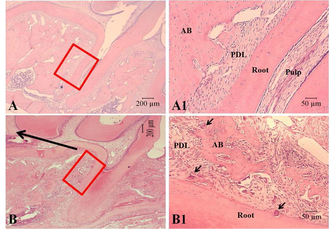 Light micrograph of upper molar teeth with H&E stain. (A) In control sample, it can be seen relatively intact root, alveolar bone and periodontal ligament. (A1) High magnification of the box in Fig. 23A confirmed that PDL make smooth boundary between the root and alveolar bone (AB). (B) Sample of tooth movement for 6 days and the direction of force (big arrow) was indicated. The morphology of PDL around the root was irregular and broad range of bone resorption is observed. (B1) High magnification of the box in Fig. 23B shows many multinucleated cells (arrows) in the root and alveolar bone surfaces.