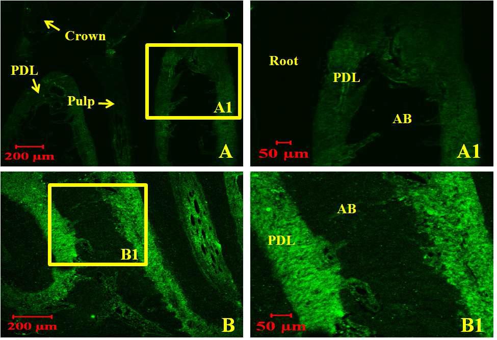 (A) Immunoreactivity against SLPI in the control sample was rarely existed in the PDL and other dental tissues. (A1) High magnification of the box in Fig. 27A also have weak reactivity. (B) Orthodontic tooth movement for 1 day sample showed strong immunoreactivity mainly existed in the PDL. (B1) Higher magnification of the box in Fig. 27B also confirmed the strong reactivity against SLPI.