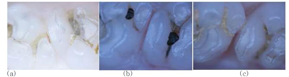 Stereoscopic findings after orthodontic tooth movement for 6h (a), 2d (b) and 6d (c).