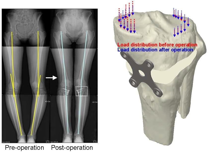 The structure of varus on coronal plane and hightibial osteotomy using manipulation fixation device