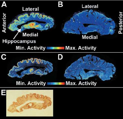 [18F]FDDNP human brain autoradiographyA, C : AD환자, B, D : 정상인