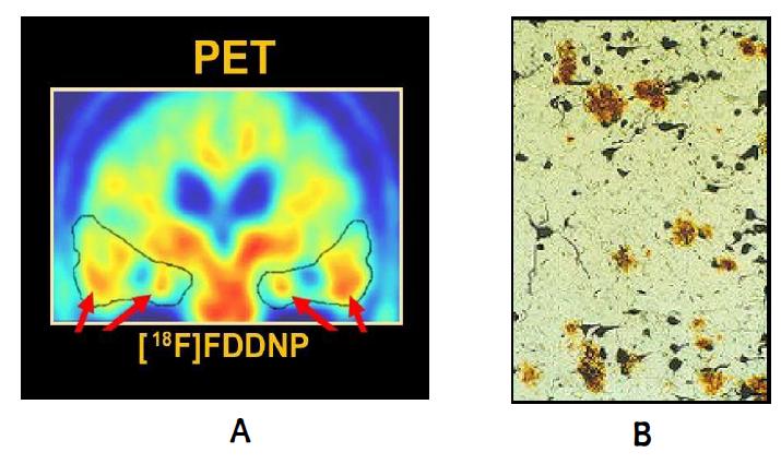 A : 살아있는 AD환자의 [18F]FDDNP PET 영상. B : 사망한 AD환자의 뇌에 생성된 노인성반과 신경섬유뭉치.