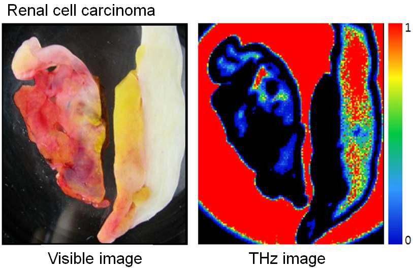 renal cell carcinoma의 THz 반사 영상.