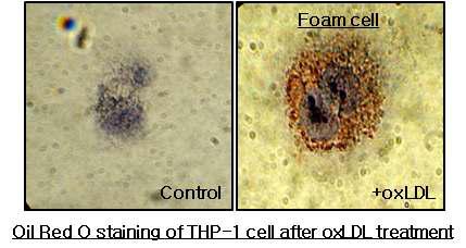 oxLDL에 의한 세포에서의 foam cell 형성.
