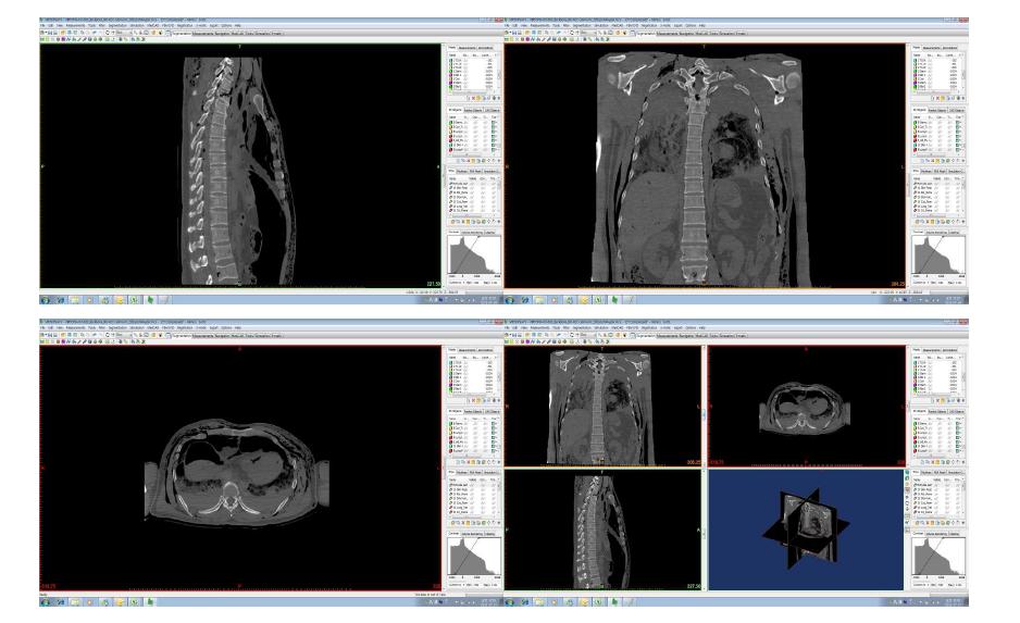 Mimics 프로그램으로 불러들인 변사자 CT 촬영 2D 이미지