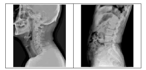 Examples of X-ray images at both cervical spine and thoracic spine