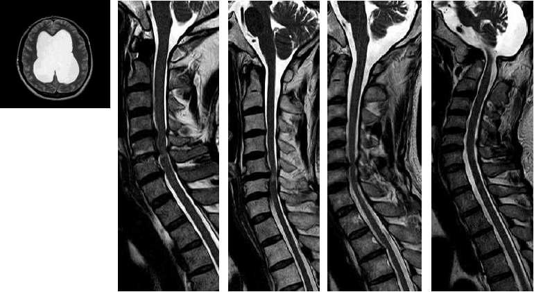 Cases of MRI images of dropouts