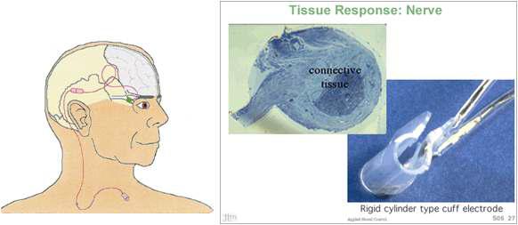 [시신경 자극기의 개념도와 시신경을 자극하기 위한 Cuff 전극]