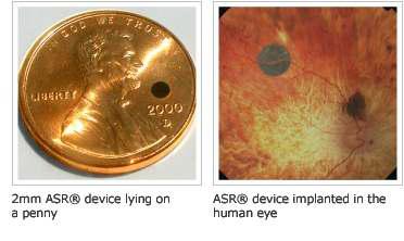 [Optobionics의 artificial silicon retina(ASR)]