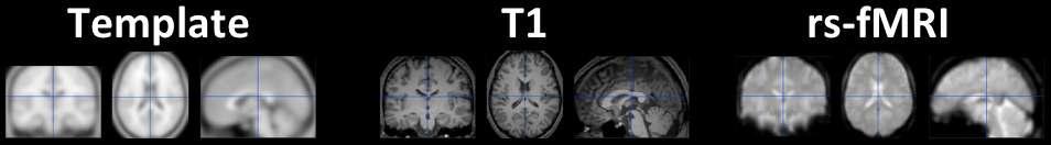 정규화된 고해상도 구조영상 (가운데), 정규화된 기능자기공명 영상 (오른쪽): SPM8의 표준 공간(왼쪽, Template space)으로 T1을 정규화 하고, 이때 형성되는 transformation matrix를 이용하여 모든 rs-fMRI 영상의 정규화를 시행함