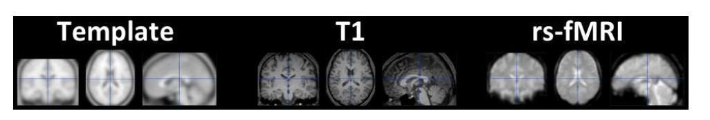 정규화된 고해상도 구조영상 (가운데), 정규화된 기능자기공명 영상 (오 른쪽): SPM8의 표준 공간(왼쪽, Template space)으로 T1을 정규화 하고, 이때 형성되는 transformation matrix를 이용하여 모든 rs-fMRI 영상을 정규화함