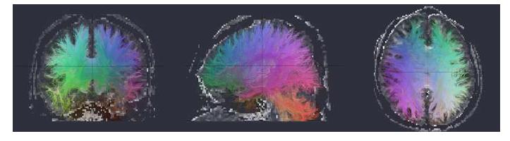 DoDTI를 이용한 신경경로 추적 예: coronal 방 향 영상 (왼쪽), sagittal 방향 영상 (가운데), axial 방향 영상 (오른쪽)