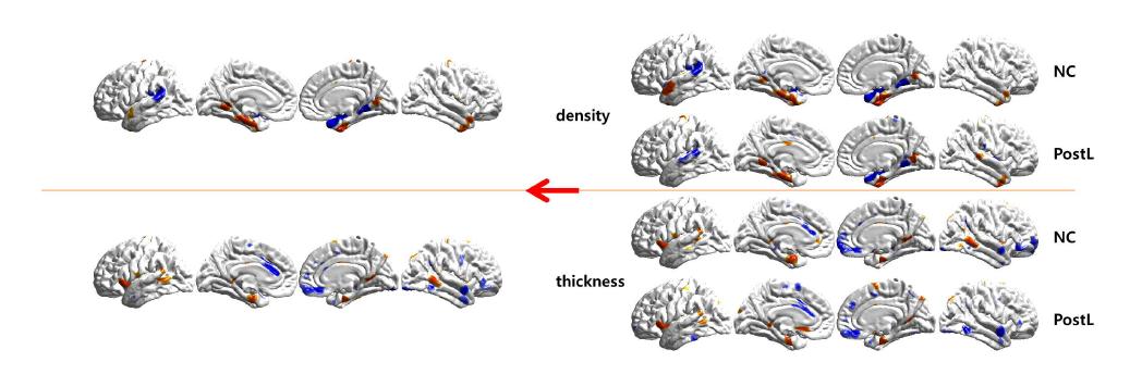 The second independent components of density and thickness map respectively. The combined map represented on the left may be attributed to the both normal controls and postlingual deaf. But the variance of the contribution is different each other.