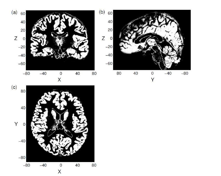 회백질(gray matter). 복셀의 밝기가 밝을수록 회백질일 확률이 크다.