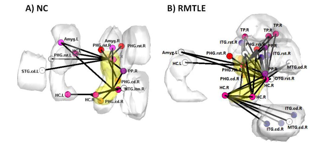 우측 해마에서의 우측 내측측두엽 간질환자군(RMTLE)의 비정상적 연결성