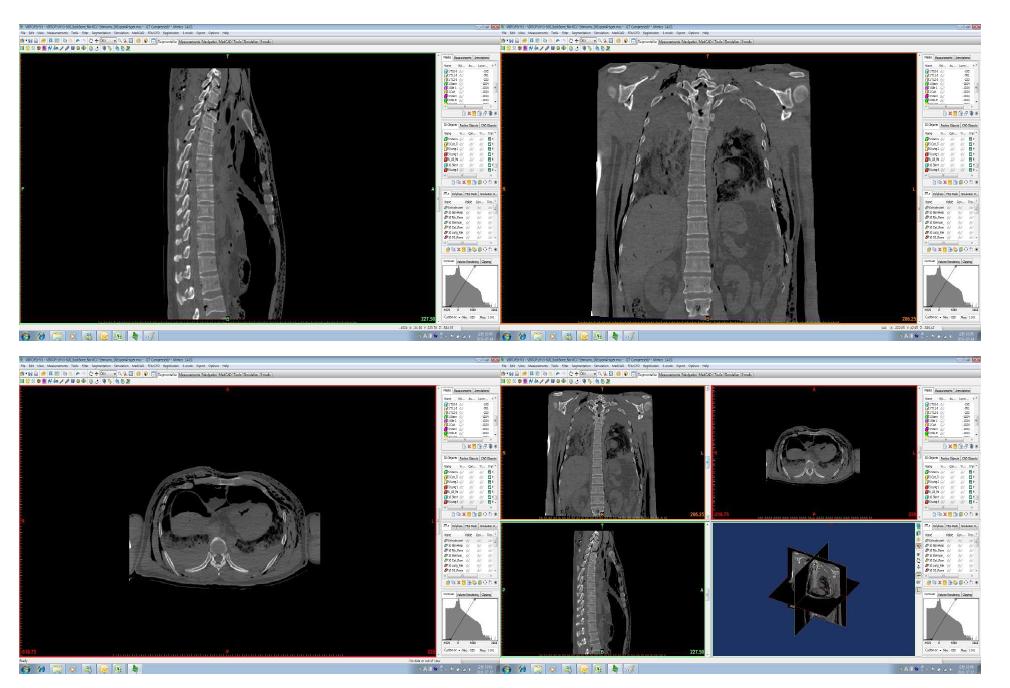 Imported CT image data in Mimics program