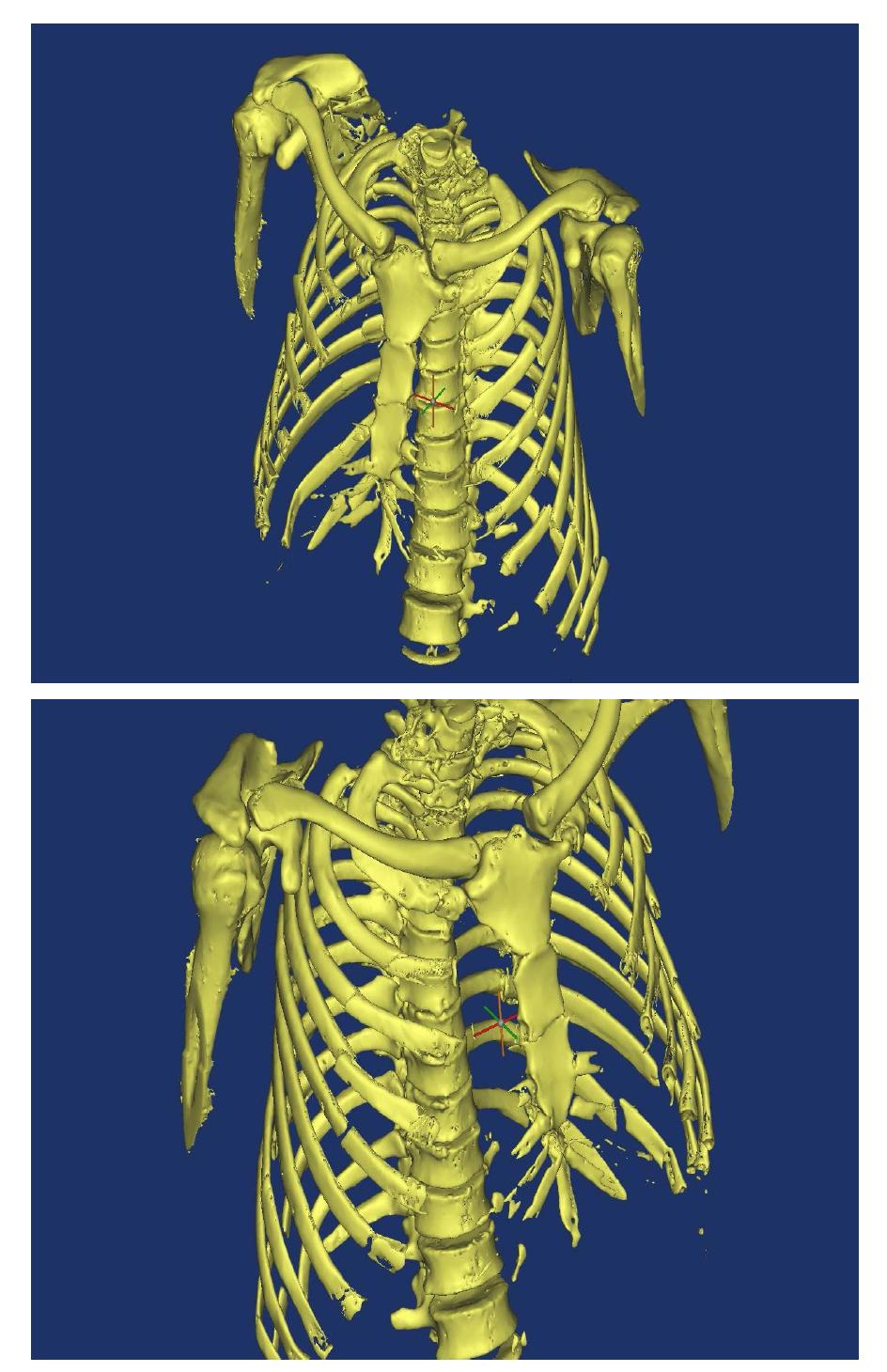 Transferred digital bone model from CT image data_front view