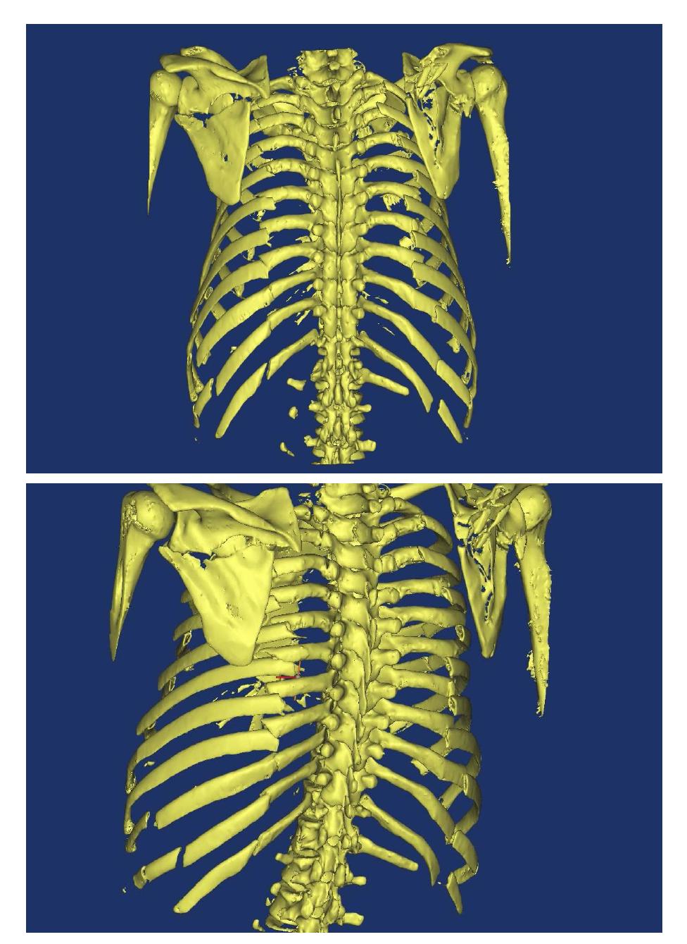 Transferred digital bone model from CT image data_back view