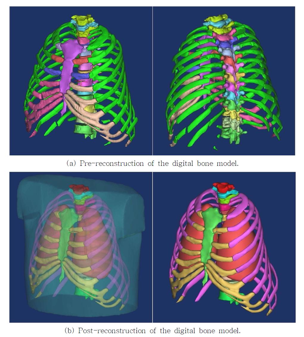 Reconstruction of the digital bone model’s damaged parts