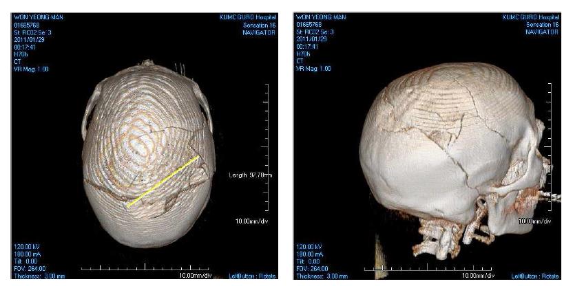 The 3-dimension computed tomography of the damaged human's skull