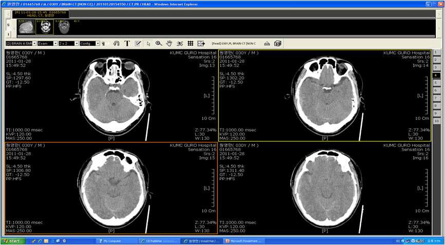 The 2-dimension computed tomography of the damaged human's skull